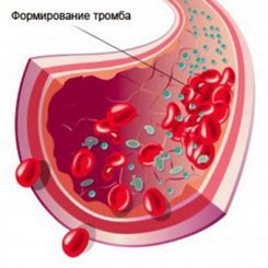 Тромбофлебит легких лечение