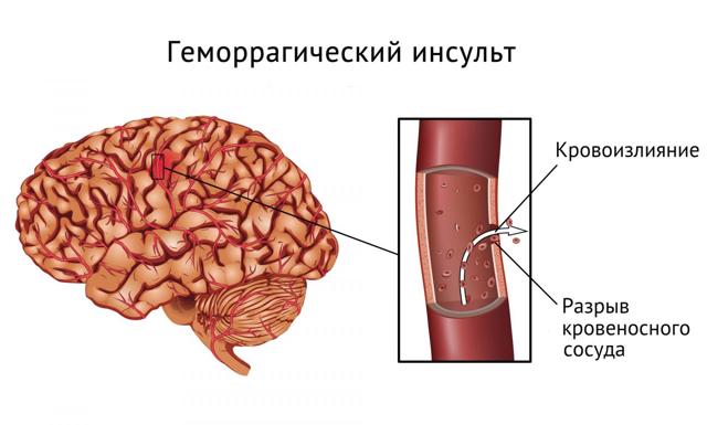 Перепады артериального давления причины и лечение - Лечение гипертонии