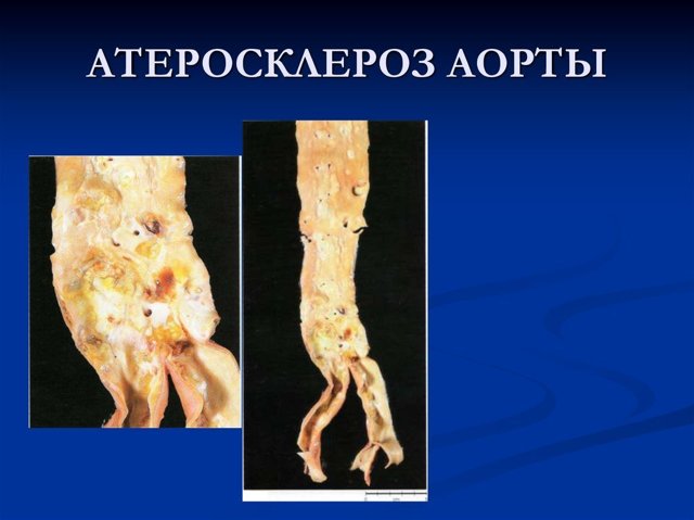 Нестенозирующий атеросклероз артерий