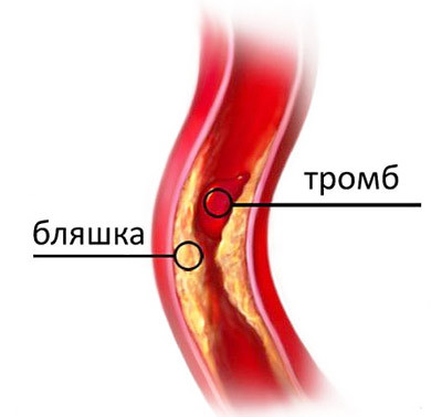 Симтомы, диагностика и лечение закупорки кровеносных сосудов