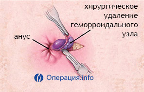 Операция на сердце удаление тромба - Все про варикоз