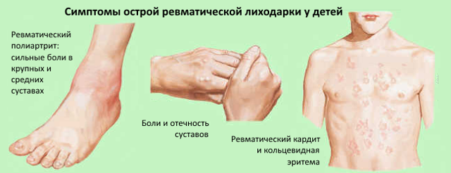Антистрептолизин-О (АСЛ-О)