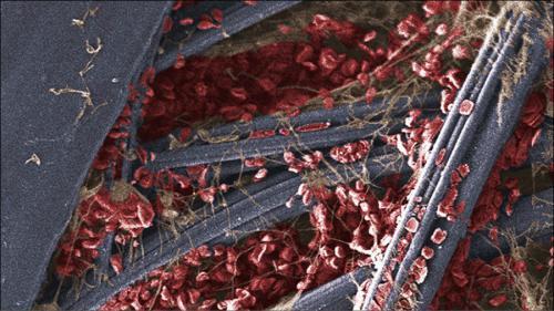 Свертываемость крови – норма