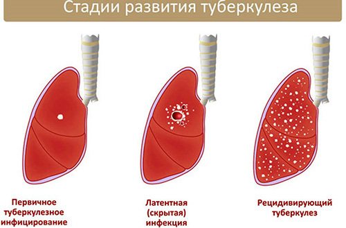 Признаки легочного кровотечения и неотложная помощь
