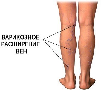 Тяжесть в ногах: причины и лечение