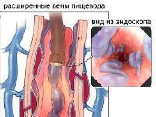 Воротная вена печени 9 мм - Лечение печени