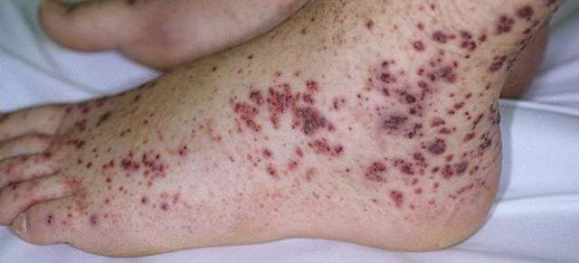 Идиопатическая тромбоцитопеническая пурпура.