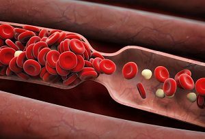 Застой в малом тазу у мужчин симптомы. Венозный застой крови в малом тазу и его последствия