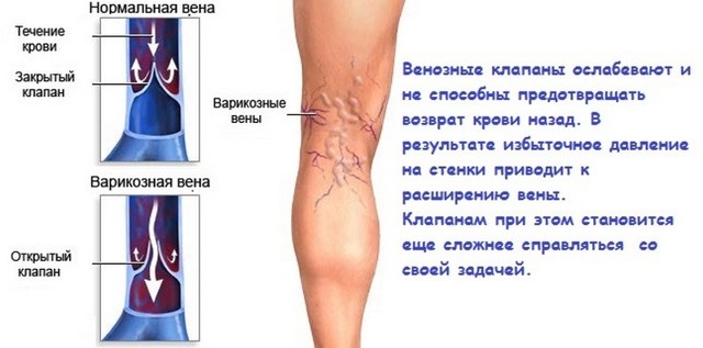 Внутренний варикоз на ногах (скрытый): симптомы и лечение