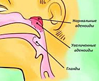Аденоиды у детей клинические симптомы и лечение