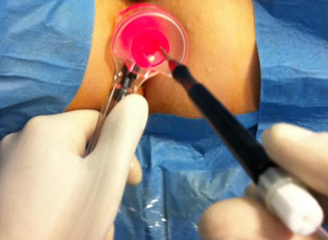 Удаление геморроя - операция лазером и другие методы хирургического лечения, цена и отзывы