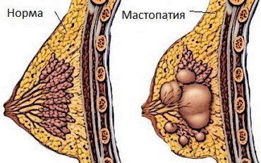 Боли под грудью: причины, диагностика и лечение