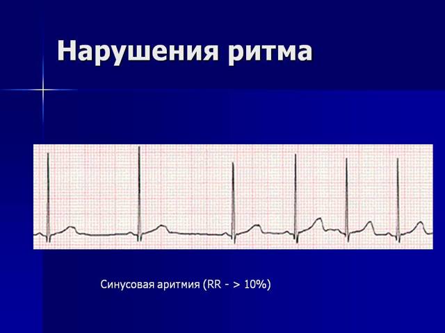 Виды аритмии сердца — типы, разновидности и их главные особенности