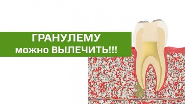 Гранулема на корне зуба: что это такое, симптомы, лечение в домашних условиях