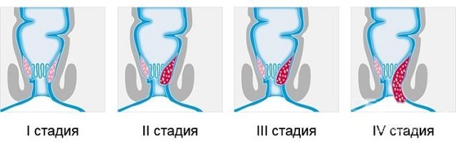 Геморрой при беременности - признаки, симптомы, причины и лечение