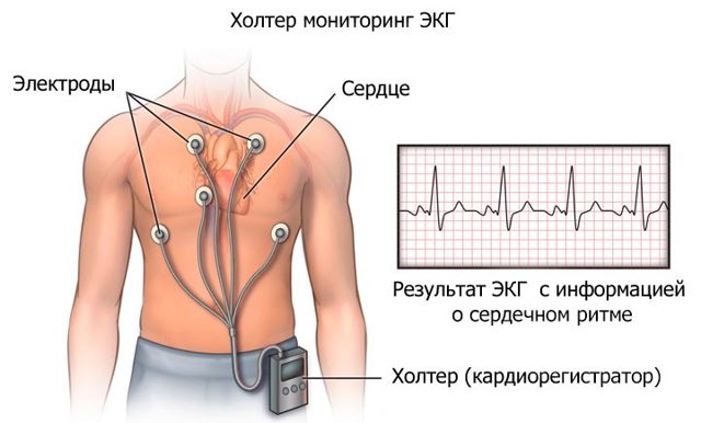 Когда возникает дефицит пульса и как определяется