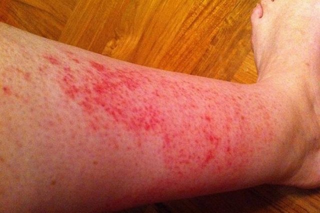 Чешется раздражение на коже: фото у ребенка на руках, коже головы, после бритья и как выглядит?