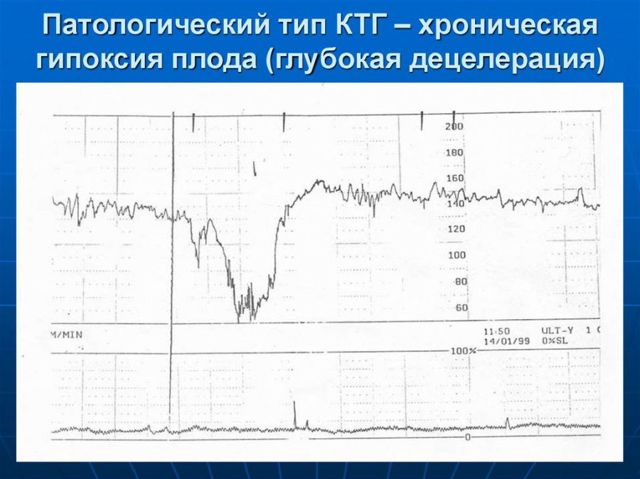 КТГ плода: расшифровка анализа, нормы и отклонения