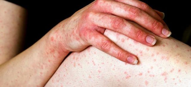 Васкулит мозга