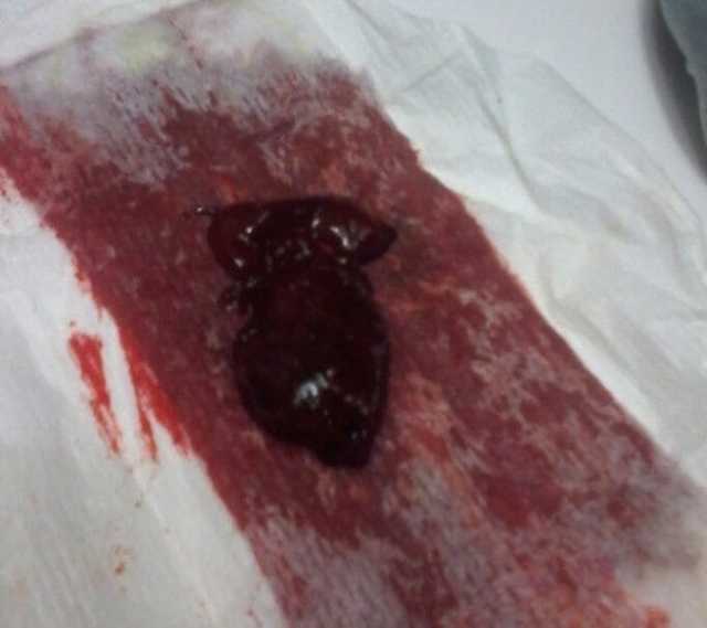 Как остановить маточное кровотечение в домашних условиях?