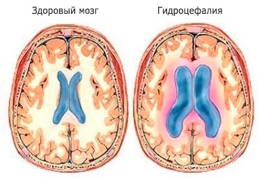 Симптомы и лечение повышенного внутричерепного давления