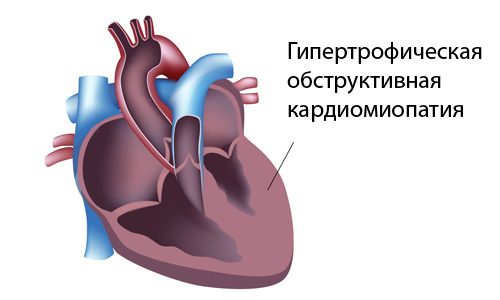 Гипертрофия мжп сердца что это. Гипертрофия мжп что это