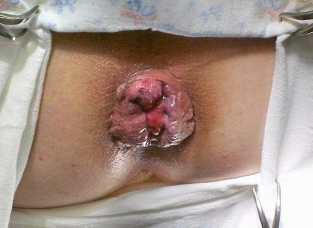 Через сколько проходит геморрой после родов? - Mamapedia