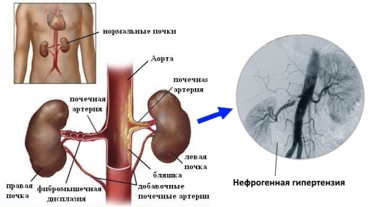 Фозиноприл - 1 отзыв, инструкция по применению