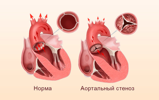 Как снизить сердечное давление в домашних условиях