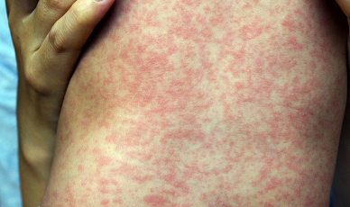 Красные пятна на теле у взрослого - появились красные пятнышки на лице