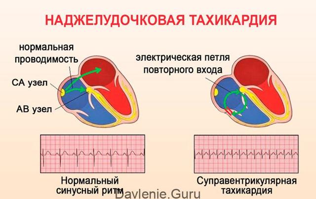 Пульс и давление при простуде