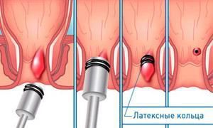 Хронический геморрой – лечение хронического геморроя, симптомы и признаки