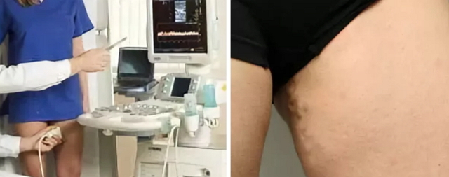 Варикозное расширение вен малого таза – симптомы, лечение и причины