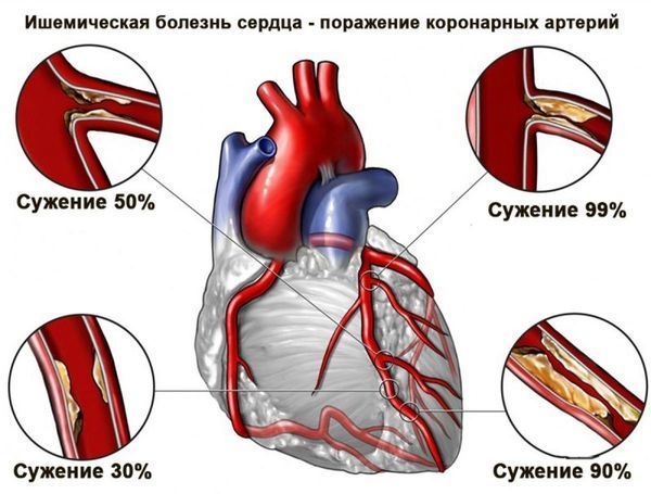Таблетки от ишемической болезни сердца