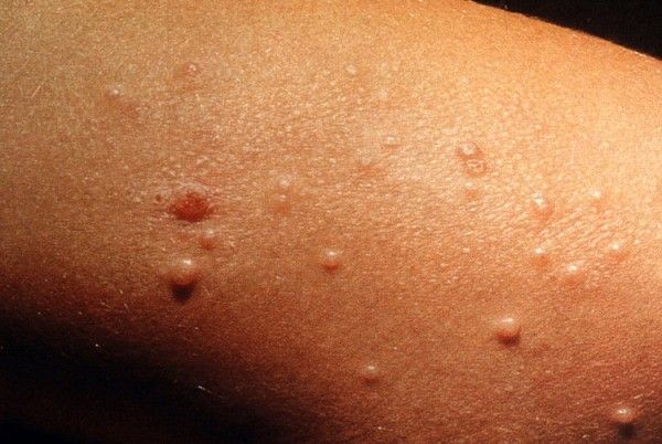 Лечение лямблиоза у взрослых медикаментозными средствами. Детальные схемы лечения и дозировка препаратов. Лямблии у взрослых: симптомы и лечение 18964 0