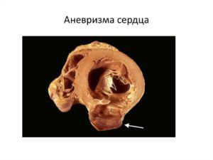Аневризма сердца - Боль в Сердце