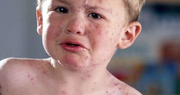 Тромбоциты понижены, лейкоциты понижены