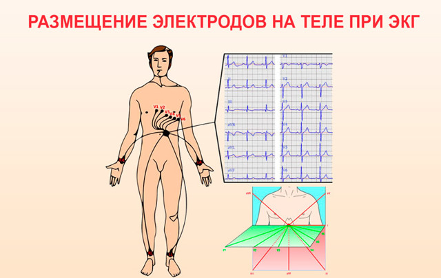 Картинки ЭКГ при нарушениях ритма
