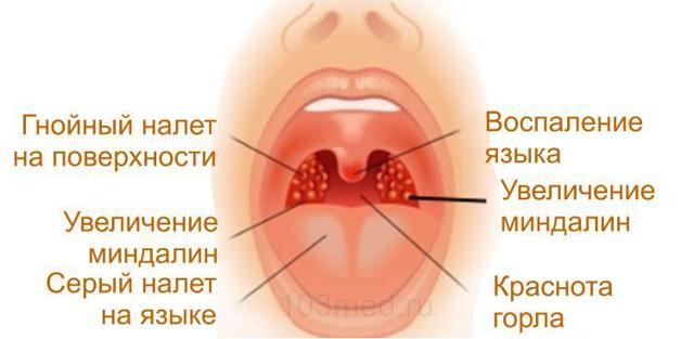 Гнойная ангина у взрослого: лечение быстро в домашних условиях, симптомы