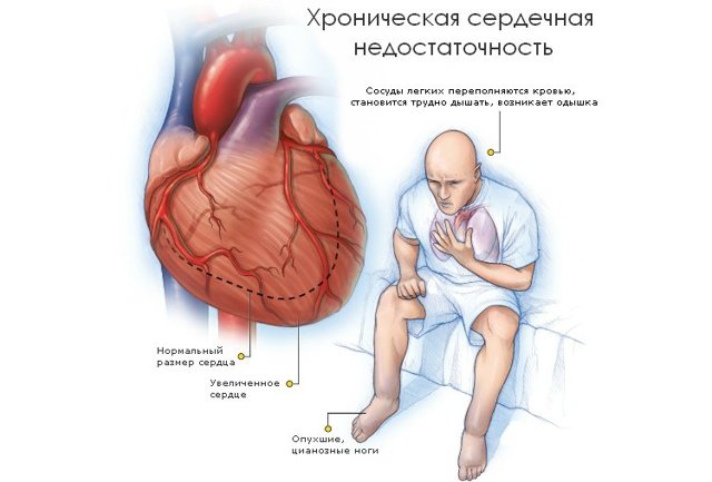 Лечение сердечной одышки народными средствами