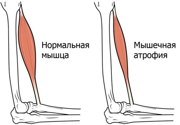Мазь при полинейропатии нижних конечностей: классификация, медикаменты, народные средства, проявления