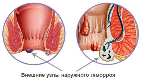 Первая стадия геморроя: лечение, причины, симптомы