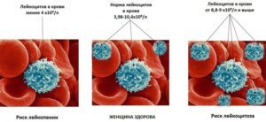 Лейкоциты в крови повышены - что это значит, причины