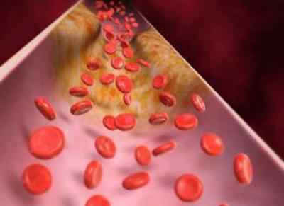 Уплотнение аорты – причины, симптомы, осложнения и лечение уплотнения аорты