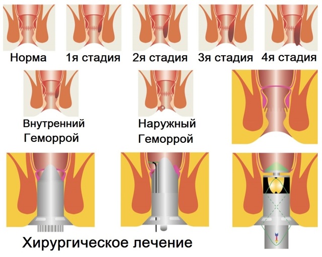 Алоэ при геморрое: как применять, отзывы