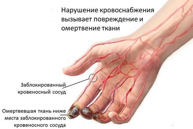 Болезнь бюргера: симптомы и лечение