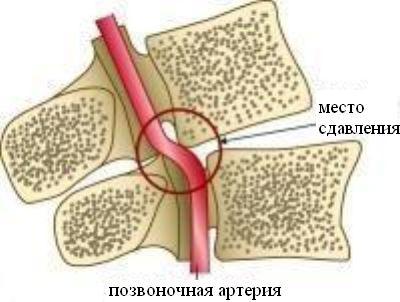 Асимметрия v4 сегментов позвоночных артерий d s. Можно ли вылечить синдром позвоночной артерии при остеохондрозе