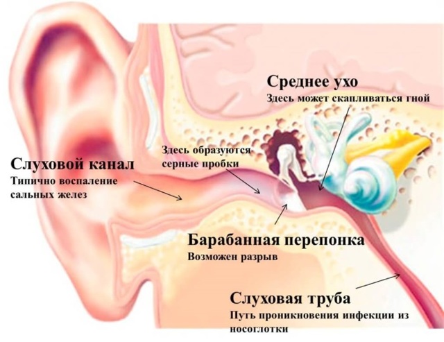 Серная пробка в ухе – лечение и удаление в домашних условиях (как почистить и пробить) 2019