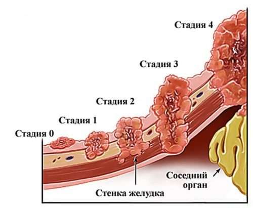 Рак желудка 4 стадии - симптомы, выживаемость и другие особенности