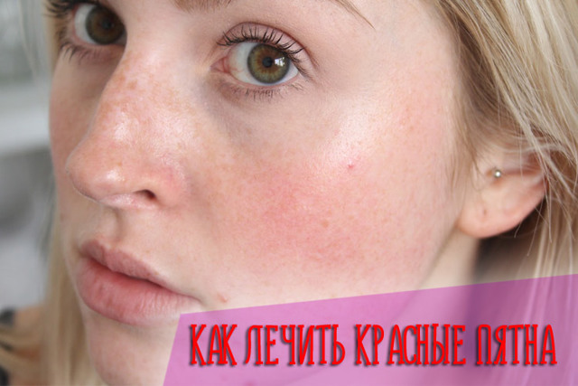 Красные пятна на лице чешутся и шелушатся — Уход за лицом
